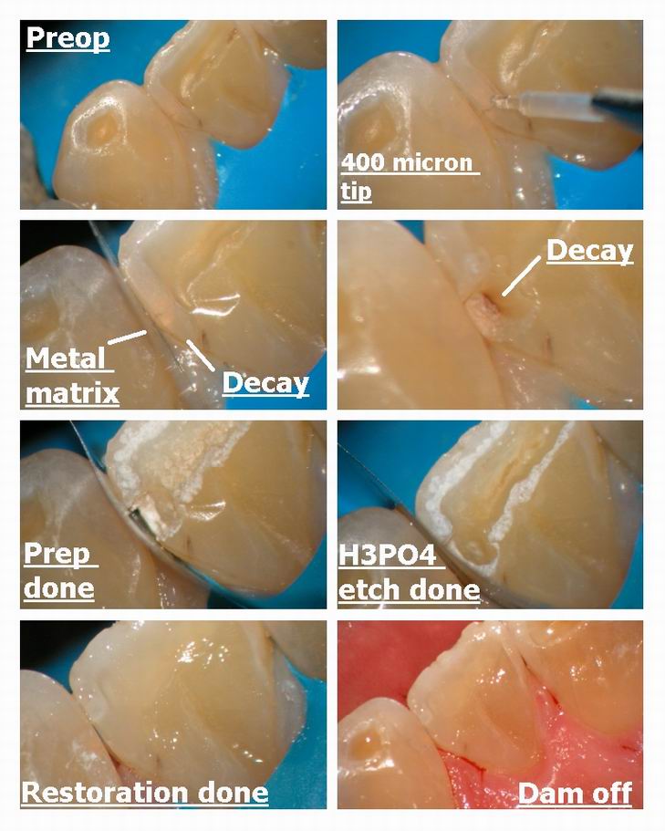 Resize of Class 3 without anesthetic.jpg